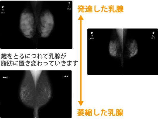 マンモグラフィー